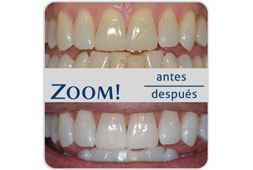 Blanqueamiento dental Zoom