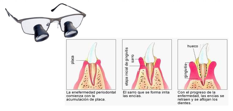 Microcirugía periodontal en Gijon