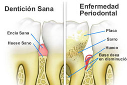 Tratamientos periodontales en Gijón